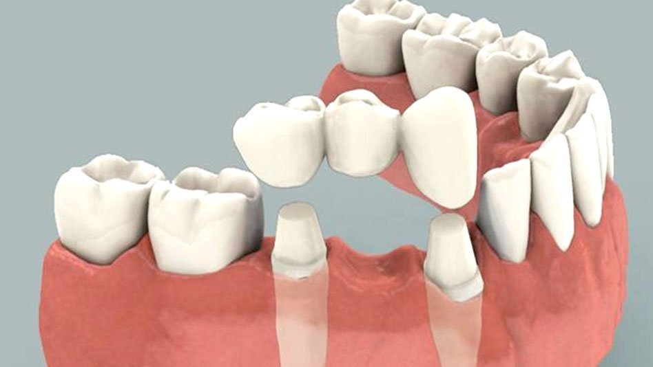 Model showing a porcelain fixed bridge supported by prepared teeth
