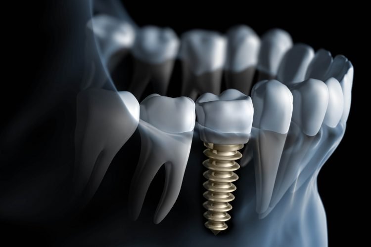 Illustration of a dental implant replacing a missing tooth root