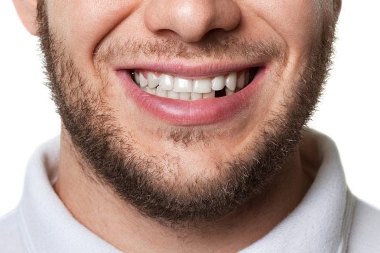 Man smiling with a missing front tooth