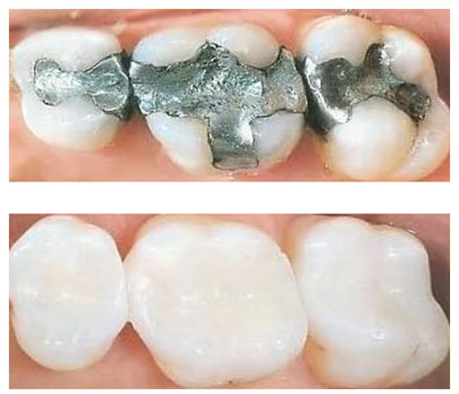 Before-and-after view of metal fillings replaced with tooth-colored fillings