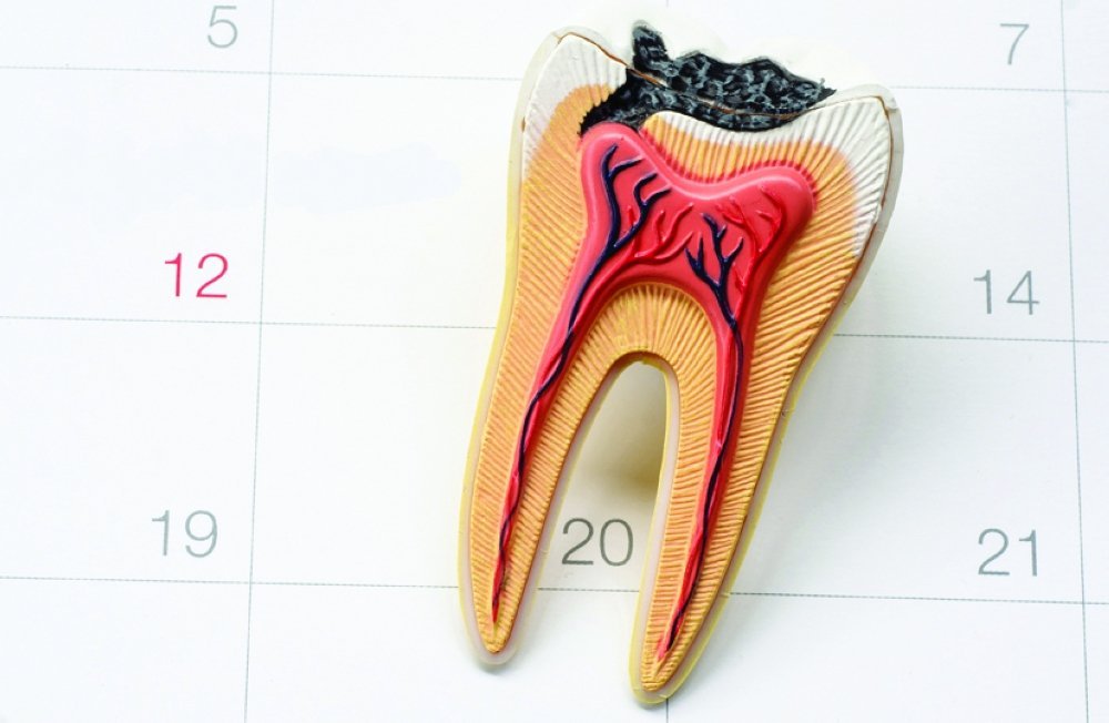 Cross-section model showing decay reaching the tooth pulp