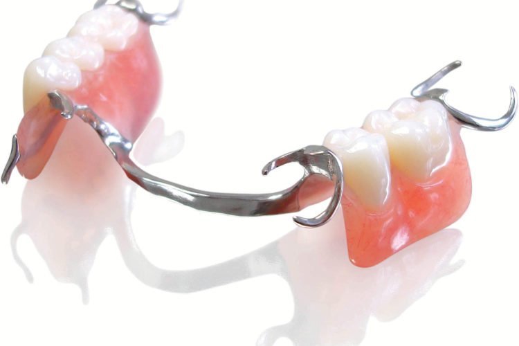 Removable partial denture with a metal framework