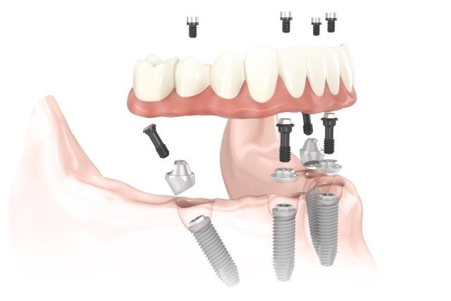 Illustration of an implant-supported full-arch denture