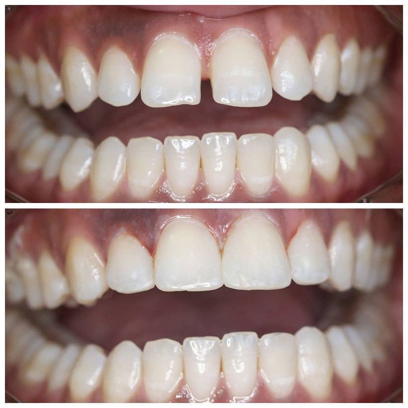 Before-and-after view of front teeth restored with direct bonding