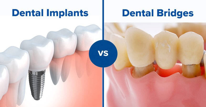 Comparison of a dental implant and a fixed dental bridge