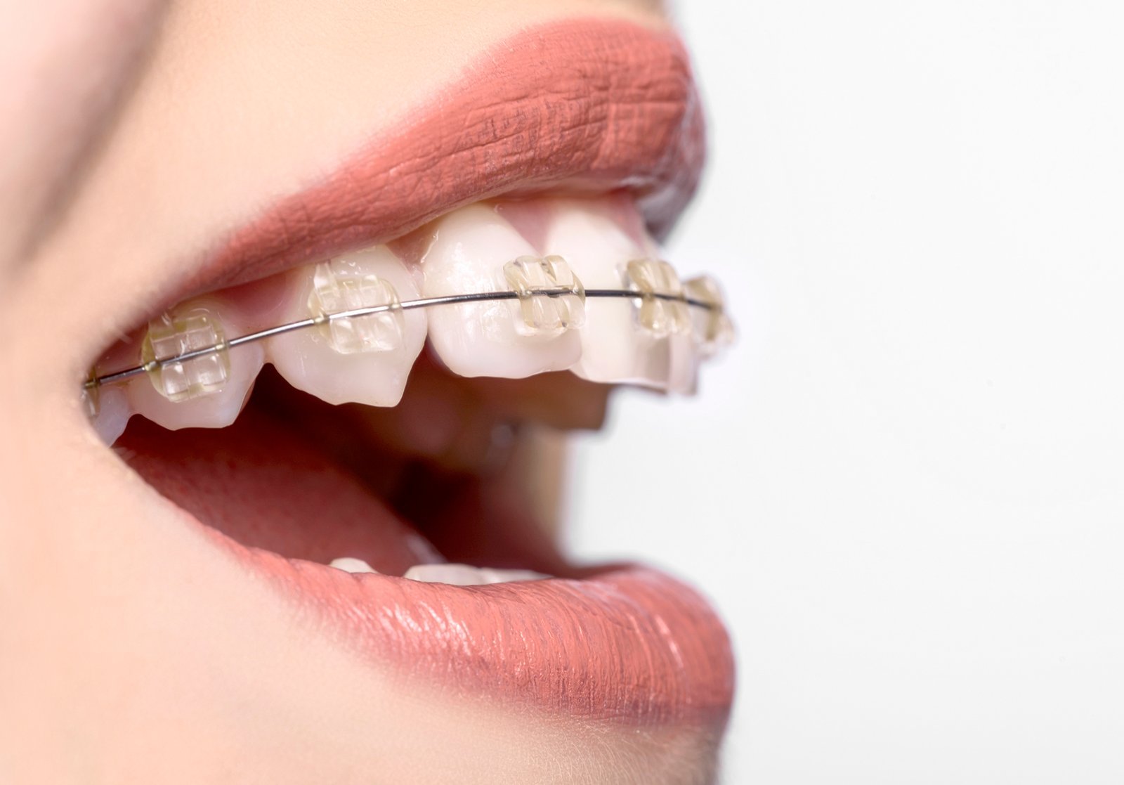 Close-up of clear ceramic braces on a patient’s teeth
