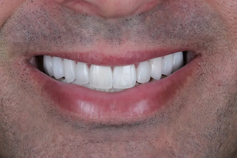 Case 1 smile after treatment