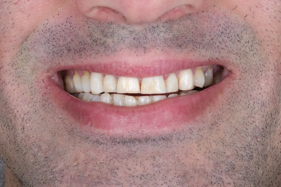 Case 1 smile before treatment