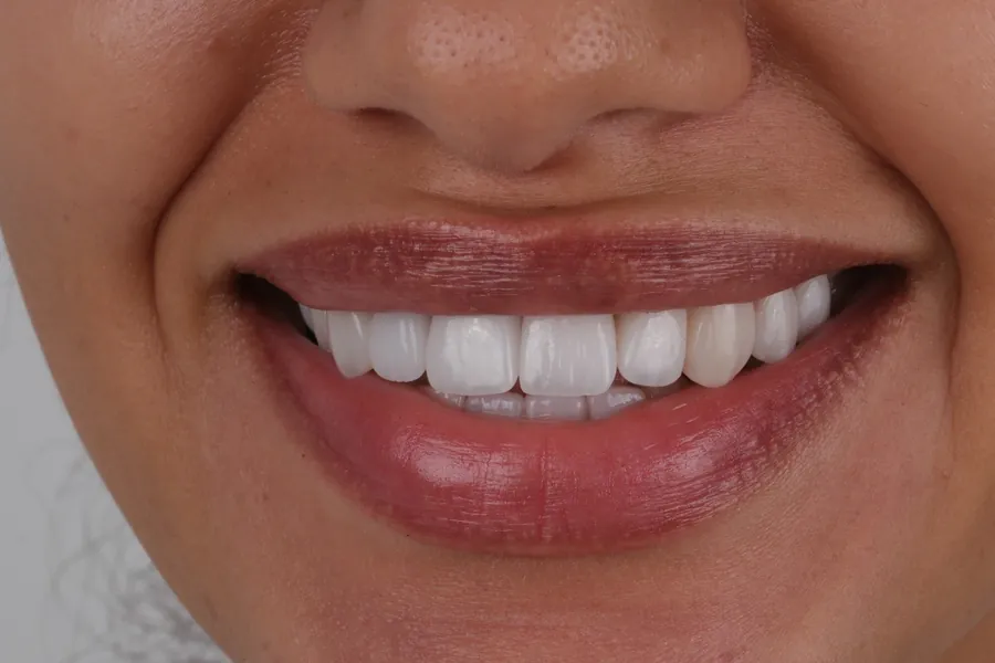 Case 2 smile after treatment