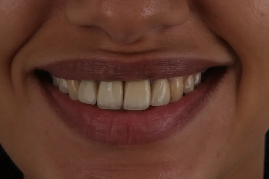 Case 2 smile before treatment