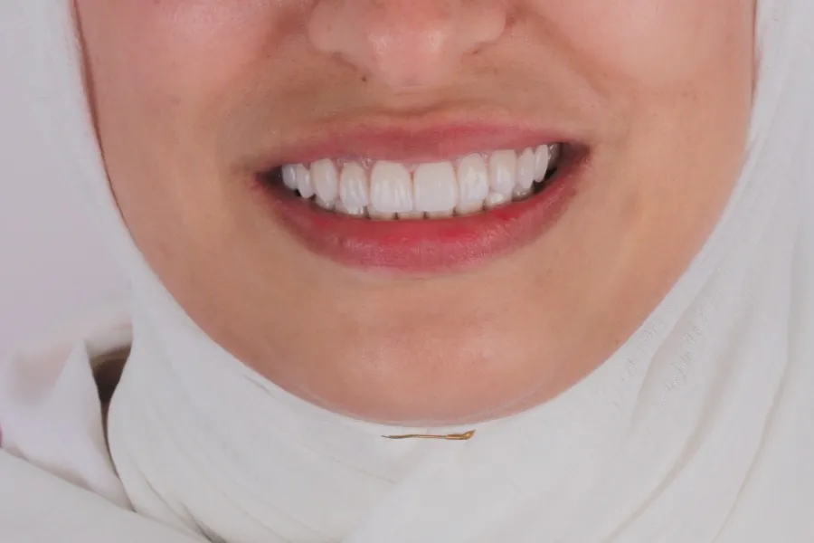 Case 3 smile after treatment