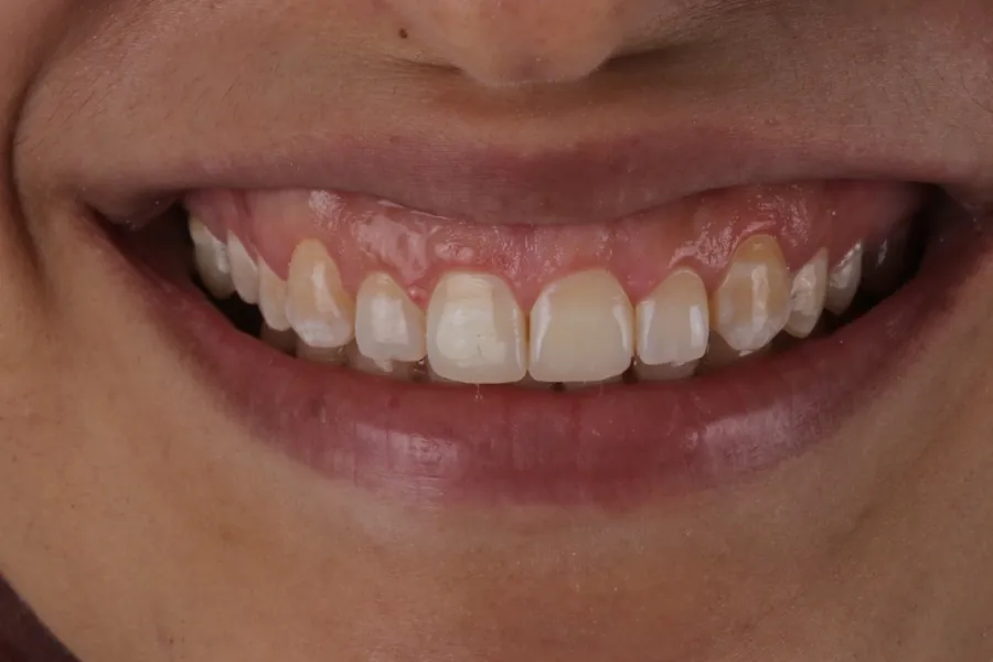 Case 3 smile before treatment