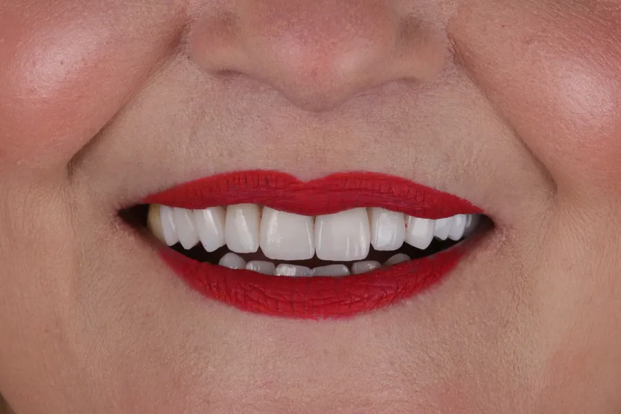 Case 4 smile after treatment