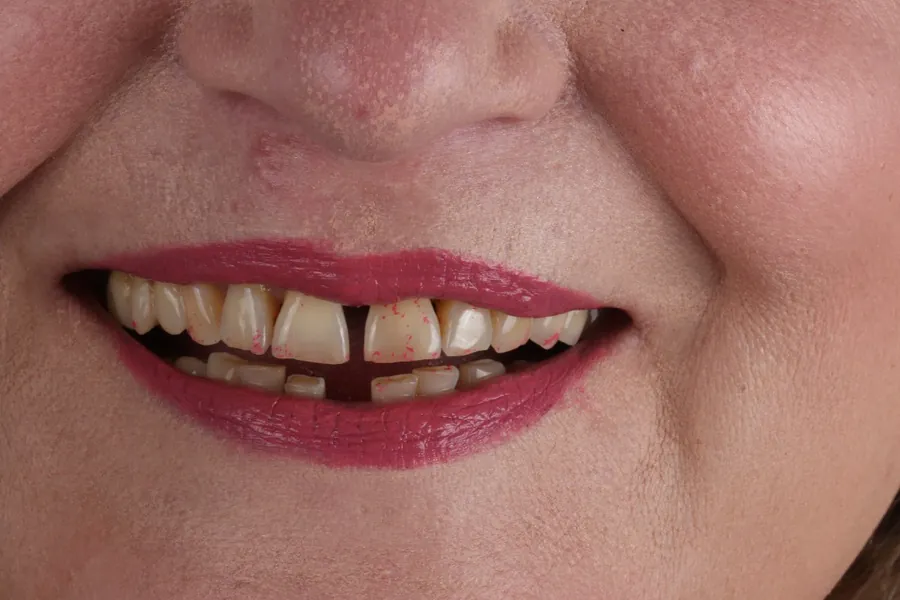 Case 4 smile before treatment