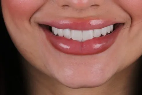 Case 5 smile after treatment