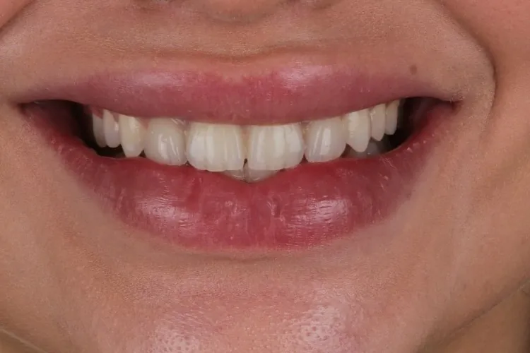 Case 5 smile before treatment